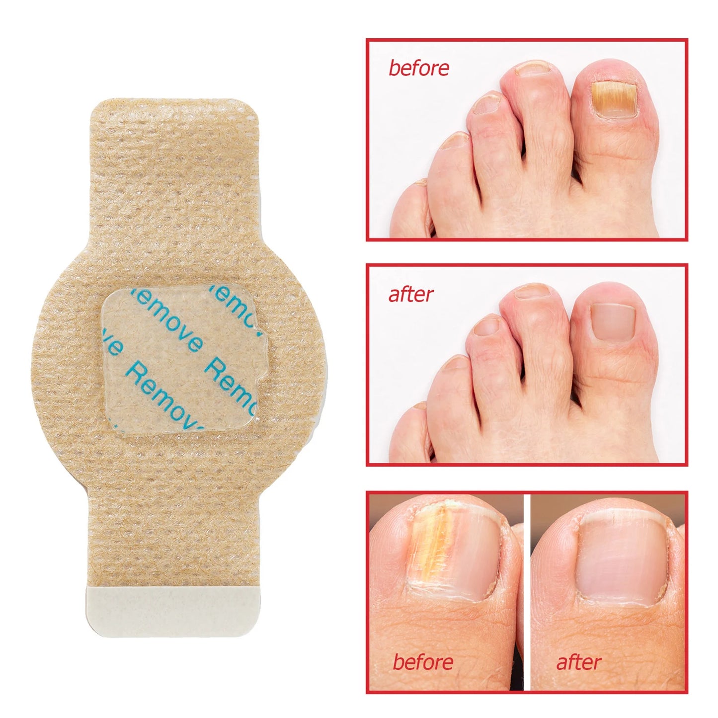 Toenail Fungus Treatment Patches Fast-Acting Nail Discoloration Treatment for Brittle Peeling Breaking Thin Nails
