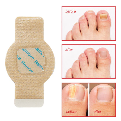 Toenail Fungus Treatment Patches Fast-Acting Nail Discoloration Treatment for Brittle Peeling Breaking Thin Nails