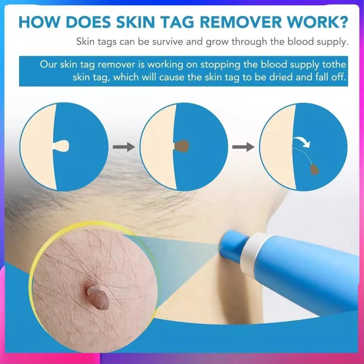 Skin Tag Removal Mole Wart Removal Facial Mole Wart Microstrip Tag Removal Kit Automatic Mole Remover Tool with Cleansing Swabs