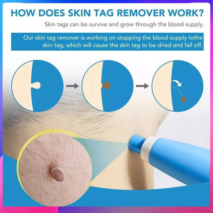 Skin Tag Removal Mole Wart Removal Facial Mole Wart Microstrip Tag Removal Kit Automatic Mole Remover Tool with Cleansing Swabs
